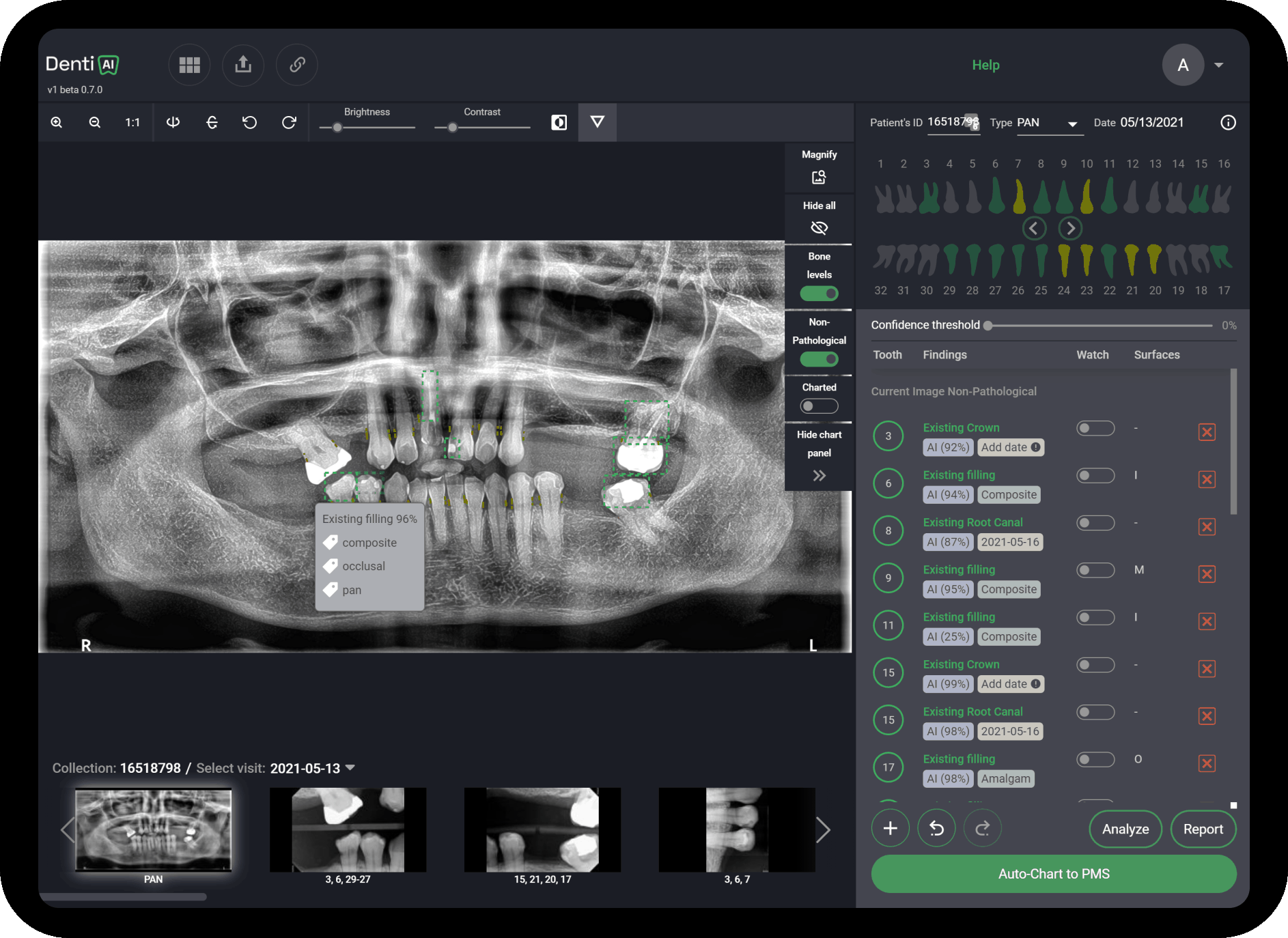 Denti AI AI For Dental X Ray Imaging And Voice Charting